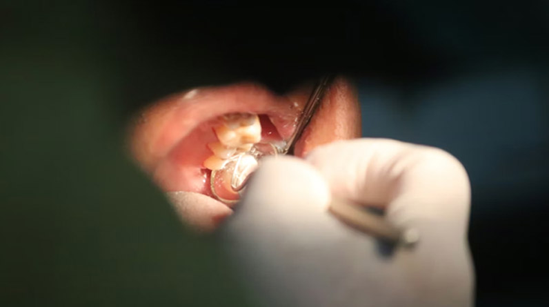 What-to-Expect-During-Wisdom-Teeth-Removal-Procedures